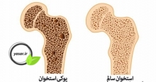 پیشگیری و اهمیت بیماری پوکی استخوان